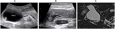 Retrospective Analysis of the Accuracy of High-Frequency Ultrasound for Pancreaticobiliary Maljunction in Pediatrics at a Single Center